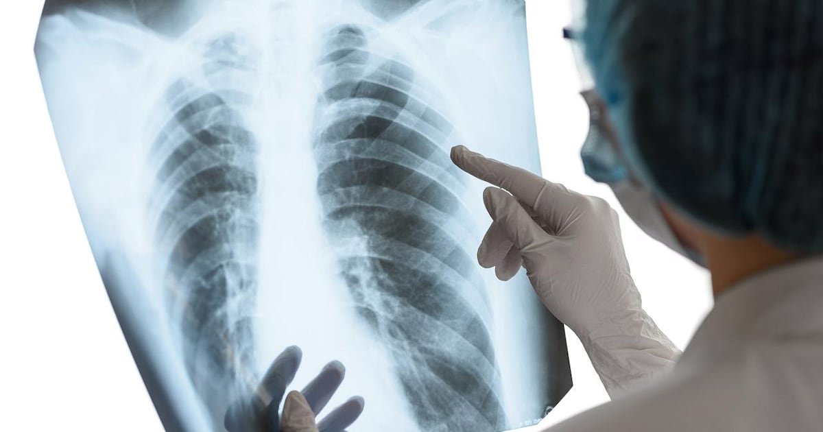Casos de tuberculosis en México: ¿Cuáles Hjo los Síntomas?
