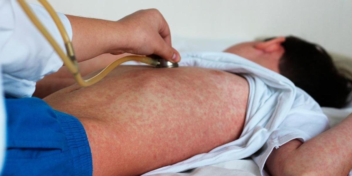 Sarampión se incrementa en México; en américa se Posiciona en Segundo Lugar de Casos Confirmados